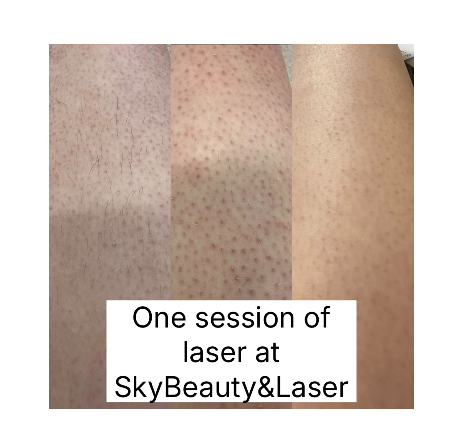 Before and after laser hair removal showing smoother skin
